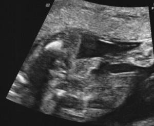 Baby 2 ultrasound